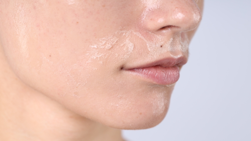 Krupni plan lica sa vidljivim perutanjem i suvim delovima kože oko obraza i usana