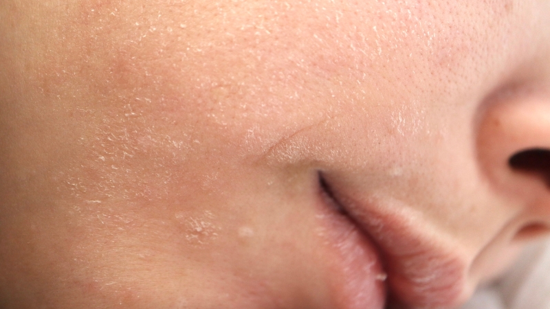 Krupni plan obraza i usana sa vidljivim suvim delovima i perutanjem kože lica